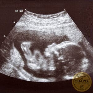 ultrasound baby photo picture nft